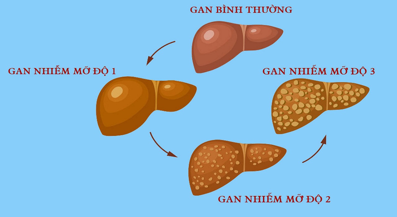 Bệnh gan nhiễm mỡ và chế độ dinh dưỡng cho người bị gan nhiễm mỡ