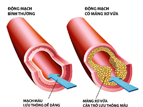 Bênh mỡ máu cao và phương pháp giảm mỡ máu